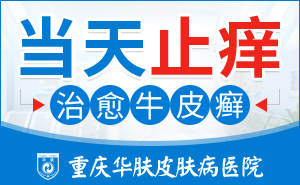 重庆治疗牛皮癣哪家医院好