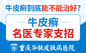 重庆看牛皮癣医院在哪
